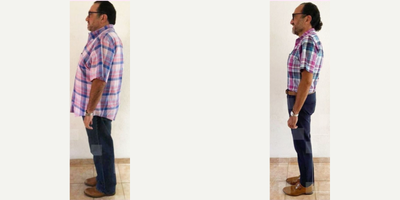 45-54 year old man treated with Orbera Gastric Balloon - 45-54 year old man treated with Orbera Gastric Balloon