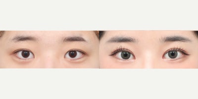 18-24 year old woman treated with Double Eyelid Surgery, Eyelid Surgery, Ptosis Surgery, Canthoplasty - She had non-incisional eyelid with ptosis correction (revision) with epicanthoplasty
