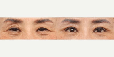 65-74 year old woman treated with Eyelid Surgery, Canthoplasty - She had upper blepharoplasty, lateral canthoplasty, lower lateral canthoplasty