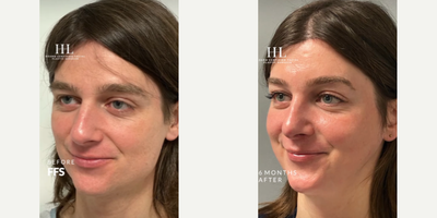 Woman treated with Facial Feminization Surgery - Woman treated with Facial Feminization Surgery through Forehead Reduction, Type 3 Brow Bone Reconstruction, direct Brow Lift, Cheek Augmentation using implants, Facelift, Jaw Reduction, Adam's Apple Reduction, Rhinoplasty, and a Subnasal Lip Lift. Patient is shown before and 6 months post-op.