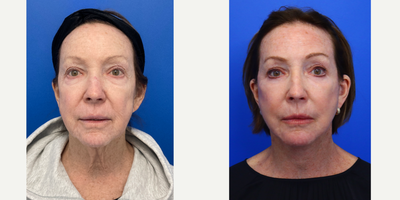 65-74 year old woman treated with Facelift, Eyelid Surgery, Neck Lift, CO2 Laser, Facial Fat Transfer - 70 year old 3 months after Facelift, Neck lift, upper and lower blepharoplasty, facial fat transfer and co2 laser skin resurfacing.