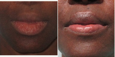 45-54 year old woman treated with Lip Reduction - 52-year-old woman treated Lip ReductionHeight: 58 Weight: 186 pounds BMI: 27.9 Time After Surgery: 1 Month
