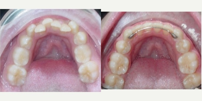 17 or under year old woman treated with Damon Braces - Treatment time: 14 months  90% deep bite with moderate to severe lower crowding.  Treated non-extraction with Damon braces