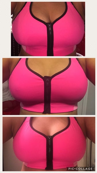 34DD Breast Reduction , Not Small Enough - Review - RealSelf