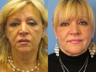 Exilis skin tightening of face - 
	Exilis skin tightening of mid and lower face in 60 year old woman. 4 treatments, one week apart. Photo after 3 months. No other treatments were done.
