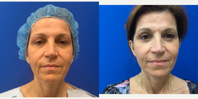 45-54 year old woman treated with MACS Facelift - 54-year-old female before and six weeks after MACS Mini Facelift. Note improvement of jowls and neck regions.