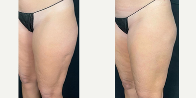 Woman treated with Aveli - The Avli cellulite treatment continues to be one of my favorite procedures. This convenient in-office procedure has no downtime besides minimal bruising and swelling, and results can be seen about a month after a single treatment.The innovative Avli technology is what makes it such a successful treatment. After local anesthesia, the device is inserted under the skin and releases (cuts) the septa which create cellulite dimples on the thighs and buttocks. Only a small incision is made so you can resume normal actives and expect to see your results improve as you heal over the next month. Easy, effective, and perfect for summer