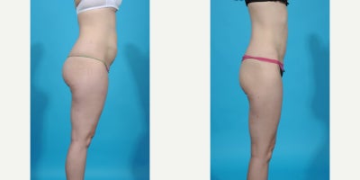 35-44 year old woman treated with Abdominal Etching, Laser Liposuction, Liposculpture, Liposuction, Power-Assisted Liposuction ( - before and after VASER ultrasound assisted liposuction abdomen/flanks; lipo 360. Liposuction is the most popular plastic surgery procedure with about 350,000 procedure done in 2023. Good candidates for liposuction have normal or near normal weight but have discrete problem areas with discrete pockets of fat. Another charateristic of a good liposuction candidate is skin quality. Younger patients with good skin quality and few stretch marks with little to no overhang or excess skin are the best candidates. Vaser is an ultrasound device that melts fat and tightens tissue making liposuction more precise with less bruising and swelling. In this case I did liposuction with VASER assistance removing about 1.5 from her abdomen and flank areas (Lipo 360).
