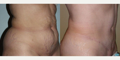 Woman treated with Tummy Tuck - Abdominoplasty