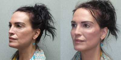 35-44 year old woman treated with Injectable Fillers - 44 year old female injected with Renuva . REnuva is an injectable tissue form that allows your own body to generate fat for volume or correct defects