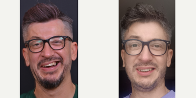 35-44 year old man treated with Facial Reconstructive Surgery - Facial Synkinesis Surgery, Selective Denervation Surgery, Selective Neurolysis Surgery, Selective Neuroectomy Surgery