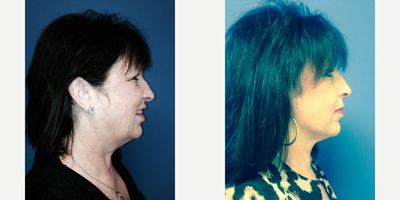 55-64 year old woman treated with Facelift - 55 year old female who underwent a Monarch Mini Lift with Smartlipo of her neck