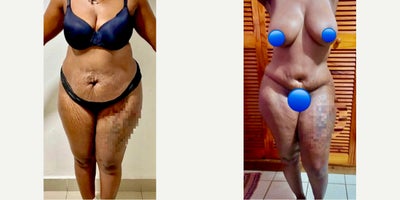 45-54 year old woman treated with Tummy Tuck, Liposculpture - 45-54 year old woman treated with Tummy Tuck, Liposculpture