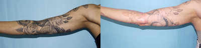 Picosure Laser tattoo removal - This patient has undergone one complete picosure treatment on the arm / sleeve tattoo.   the portion below the elbow is 10 days after the second treatment.  Notice the dramatic change after just this one treatment with the Picosure.