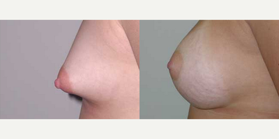 18-24 year old woman treated with Breast Implants - Height : 54WT : 135Age : 20Implant make: Mentorstyle : Saline 415 ccplacement : Placed subgland to reshape the breasts because of the tuberous breasts