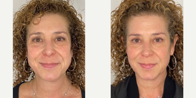 55-64 year old woman treated with Microneedling, CO2 Laser, Skin Rejuvenation - After just one 1 session RF Microneedling + CO2 micropeel! She has 2 more sessions to go.