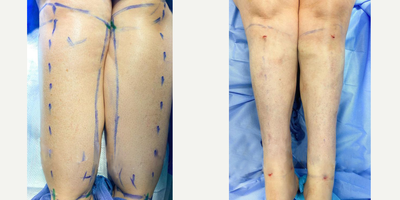 Woman treated with Lipedema Surgery - Woman treated with Lipedema Surgery