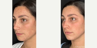 25-34 year old woman treated with Chemical Peel and Medical Grade Skincare to treat acne, hyperpigmentation, sun damage, and acn - 30 year old woman treated with Chemical Peel and Medical Grade Skincare to treat acne, hyperpigmentation, sun damage, and acne scarring