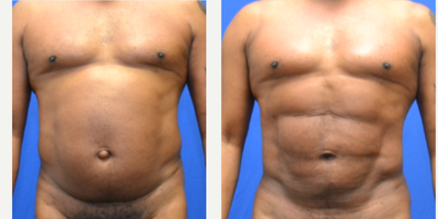 55-64 year old woman treated with Abdominal Etching - with liposuction of the upper abdomen, lower abdomen, full waistline, hernia repair and fat grafting to the buttocks