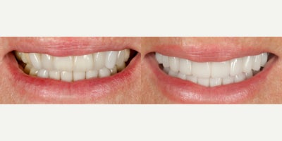 Woman treated with Smile Makeover - Function, health, and aesthetics are the trifecta in creating the perfect smile makeover.Its not solely about a picture perfect smile, but one that you can be sure lasts, functions, and is good for your overall health.Smile makeover is kinder to the tissue. The gums are less red, the recession is covered, and the materials is all porcelain-no metal!
