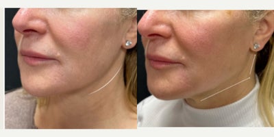 55-64 year old woman treated with Restylane Lyft, Restylane Contour, Restylane, Nonsurgical Neck Lift, Nonsurgical Facelift, Liq - Our wonderful client treated with 5 Syringes of Restalyne using the YLift technique. This technique will create a snatched jawline to help mimic the angle your jawline when you were younger.