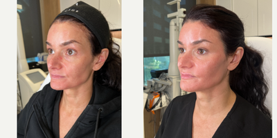 FILLER 'N THREADS COMBO - Our patient works in the industry so she would like to look her absolute best. She has noticed some signs of aging on her face, such as loss of volume in her mid face and prominent nasolabial folds. To correct this, we sculpted her face with filler as well as used threads- to give her a complete facial rejuvenation. We were able to define and sculpt her mid face leaving her cheeks contoured. We also gave her lips some natural looking plumpness, her chin that desired heart shaped look, and we didn't forget about defining her jaw for a snatched neck. All in all, she cannot believe how amazing she looks and is in love with her results!