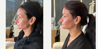 FILLER 'N THREADS COMBO - Our patient works in the industry so she would like to look her absolute best. She has noticed some signs of aging on her face, such as loss of volume in her mid face and prominent nasolabial folds. To correct this, we sculpted her face with filler as well as used threads- to give her a complete facial rejuvenation. We were able to define and sculpt her mid face leaving her cheeks contoured. We also gave her lips some natural looking plumpness, her chin that desired heart shaped look, and we didn't forget about defining her jaw for a snatched neck. All in all, she cannot believe how amazing she looks and is in love with her results!