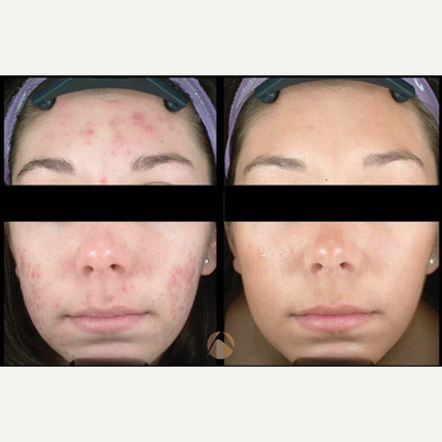 woman treated with Photodynamic Therapy - 3 Photodynamic Therapy treatments