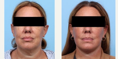 45-54 year old woman treated with Facelift, Deep Plane Facelift - A 46-year-old patient presented with concerns of facial aging, excess skin, jowls, and submental fullness. To address these issues, Dr. Wise performed a deep plane facelift, enhancing the patient's facial contours and restoring a more youthful appearance.