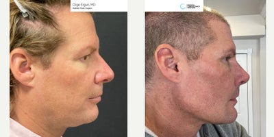 45-54 year old man treated with Chin Implant, Jaw Implants, Rhinoplasty - Chin & Jaw Implant, Rhinoplasty Surgery