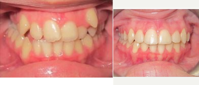 Posterior Crossbite Correction - This patient's upper arch was too narrow - we corrected her crossbite and brought in the canine that was sitting up high