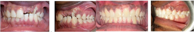 Patient with Three Impacted Teeth Treated with Braces - This patient had three impacted (stuck teeth that didn't erupt) that were brought in to achieve his dream smile!