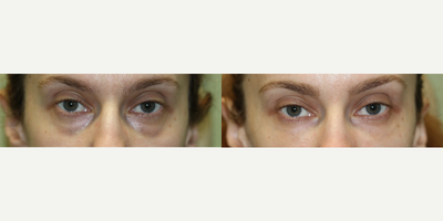 32 year old woman treated with Juvederm - Juvederm to Lower Lids