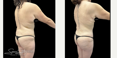 25-34 year old woman underwent a mommy makeover procedure (tummy tuck, VASER lipo, BBL, and breast augmentation) - 34 year old female underwent breast augmentation with silicone implants placed under the muscle through a small incision under the breasts. We corrected for size asymmetry of the breasts. We also performed a tummy tuck with muscle repair (abdominoplasty with diastasis recti repair), VASER assisted liposuction of the flanks and back, and a BBL (fat transfer for the buttocks and hips). Patient underwent 6 lymphatic massages post-op, and is currently undergoing Silagen scar therapy.