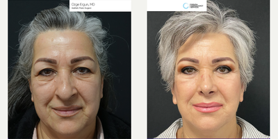 55-64 year old woman treated with Facelift, Rhinoplasty - Facelift, Rhinoplasty
