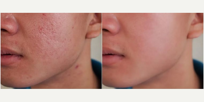 Man treated with eMatrix - Man treated with eMatrix.