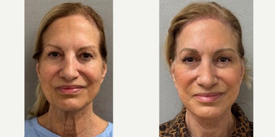 72 yo s/p Deep Plane Face and Necklift and pretrichial browlift performed under local anesthesia with sedation (twilight anesthe - 72 yo s/p Deep Plane Face and Necklift and pretrichial browlift performed under local anesthesia with sedation (twilight anesthesia) in our on site AAAA certified operating suite