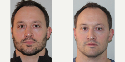 35-44 year old man treated with Sinus Surgery - Male patient that is an ex boxer with a severe deviated septum causing him to be unable to breath our of one side of his nose.