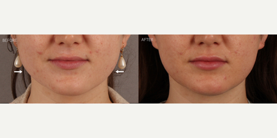 Lip Filler and Non-Surgical Jawline Slimming - 24-year-old female who expressed the desire for more lip symmetry, volume and shape. She also presented with a history of nighttime grinding and clenching, leading to significant pain and discomfort. She noted that this also correlated with enlarged masseter (chewing) muscles, making her jaw look wider. She is shown 2 weeks after masseter Botox, to treat her symptoms and narrow her jawline, and lip filler (Restylane Kysse) to her upper and lower lip. For the jawline, this is an early, subtle result, as it typically takes a full 6 weeks to see maximal jawline slimming.