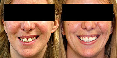 Invisalign - Invisalign