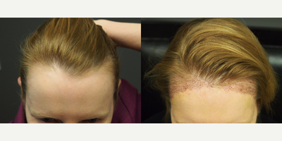 45-54 year old woman treated with Forehead Reduction with Hair Transplant - This is actuality 5 days post-op. 
Forehead Reduction with Hair Transplant to lower and round out the corners.