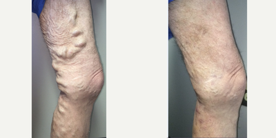 45-54 year old man treated with EVLT - Our patient had big vein surgery for his varicose veins about 10 years ago but they came back with a vengeance. After an EVLT (laser procedure) to treat his great saphenous vein, we then performed a micro-phlebectomy of his bulging varicose veins. One month later, he could not believe how much better his leg felt and looked.