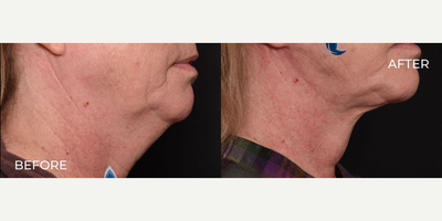 Woman treated with Thread Lift - Woman treated with Thread Lift
