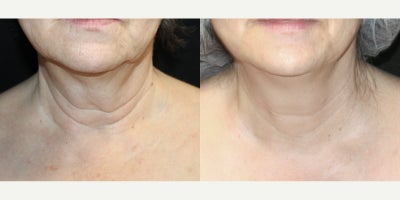 65-74 year old woman treated with Venus Freeze - Venus Freeze 6 Sessions with yearly maintenance