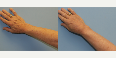 65-74 year old man treated with Hand Rejuvenation - This gentleman was treated with BBL laser wavelengths for Hand Rejuvenation.