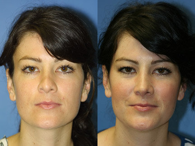 Revision Rhinoplasty - 
	A prior rhinoplasty procedure left this female with an enlarged asymmetric and bulbous tip. Refinement of the nasal tip created a smooth transition for her bridge to the nasal tip with less nostril show.

