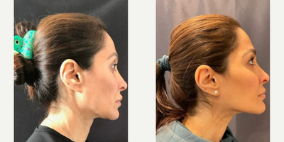 Woman treated with Emsculpt - MFACE Before & After of our very own Dr. Deborah Marciano. Noninvasive and No Downtime.