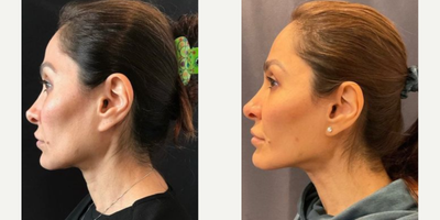 Woman treated with Emsculpt - MFACE Before & After of our very own Dr. Deborah Marciano. Noninvasive and No Downtime.
