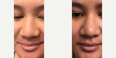 Woman treated with Microneedling - Check out this incredible before-and-after: acne scars treated with microneedling at RAREV