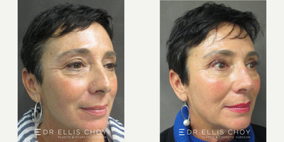 55-64 year old woman treated with Eyelid Surgery - Upper Blepharoplasty with cheek filler augmentation